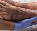 بی‌دردی زخم در افراد دیابتی نشانه پیشرفت آسیب عصبی است