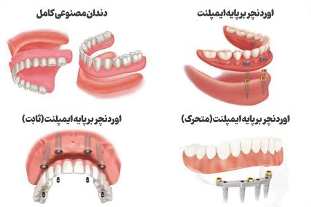 خداحافظی با لقی دندان مصنوعی؛ راهنمای جامع اوردنچر با ایمپلنت برای سالمندان