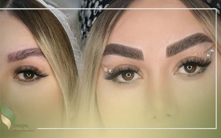 فیبروز ابرو چیست فیبروز ابرو چیست