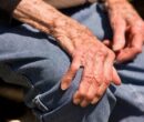 مشکل هورمون درمانی برای بیماران جراحی مفصل زانو