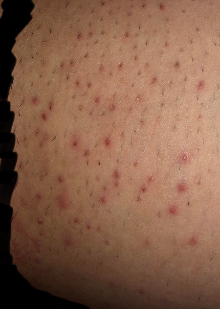 لیزر موهای زائد ناحیه تناسلی , از بین بردن موهای زائد ناحیه تناسلی,عوارض لیزر موهای زائد ناحیه تناسلی
