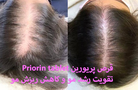 قرص پریورین تقویت رشد مو و کاهش ریزش مو