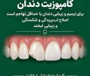 ایمپلنت، کامپوزیت یا لمینت، هر کدام برای چه مشکلی مناسب هستند؟