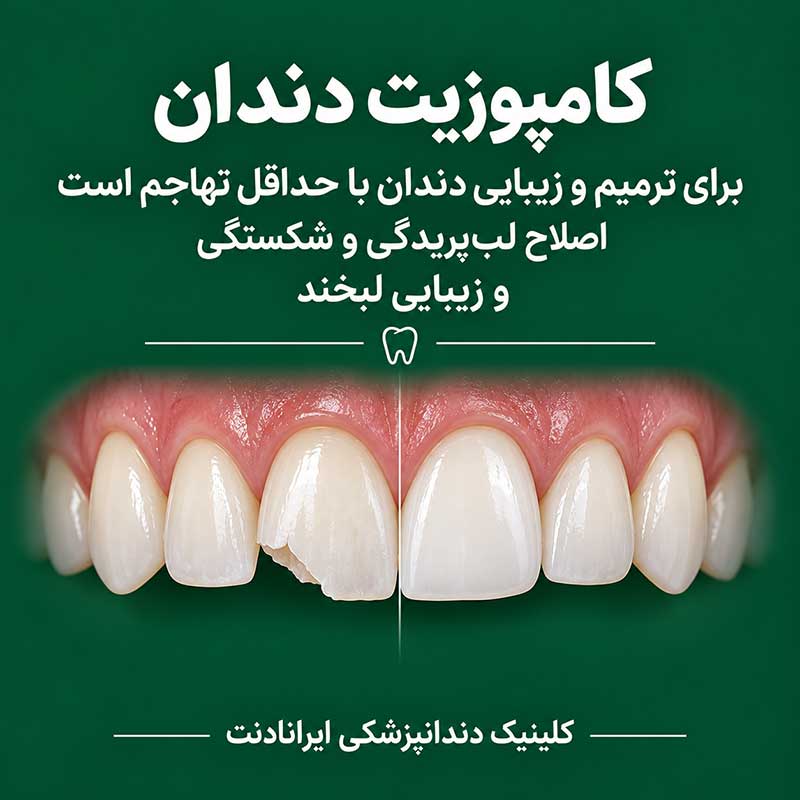 اگر دندان وجود دارد، یکی از راهکارها کامپوزیت دندان است؟ اگر دندان وجود دارد، یکی از راهکارها کامپوزیت دندان است؟
