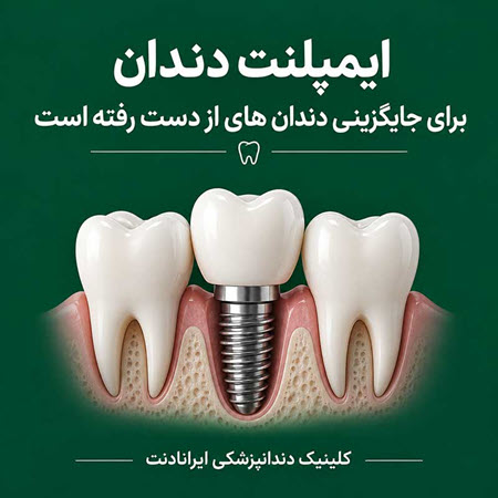 اگر دندان از دست رفته باشد بهترین راهکار برای جایگزینی ایمپلنت دندان است اگر دندان از دست رفته باشد بهترین راهکار برای جایگزینی ایمپلنت دندان است