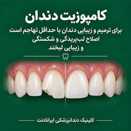 چه زمانی بجای کامپوزیت، دندان را لمینت می کنند؟ چه زمانی بجای کامپوزیت، دندان را لمینت می کنند؟