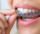 تفاوت ارتودنسی ثابت و متحرک تفاوت ارتودنسی ثابت و متحرک