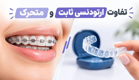 فرق ارتودنسی ثابت و ارتودنسی متحرک چیست؟ فرق ارتودنسی ثابت و ارتودنسی متحرک چیست؟