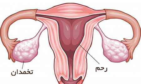 رحم دو شاخ چیست,رحم دو شاخ,علائم رحم دوشاخه